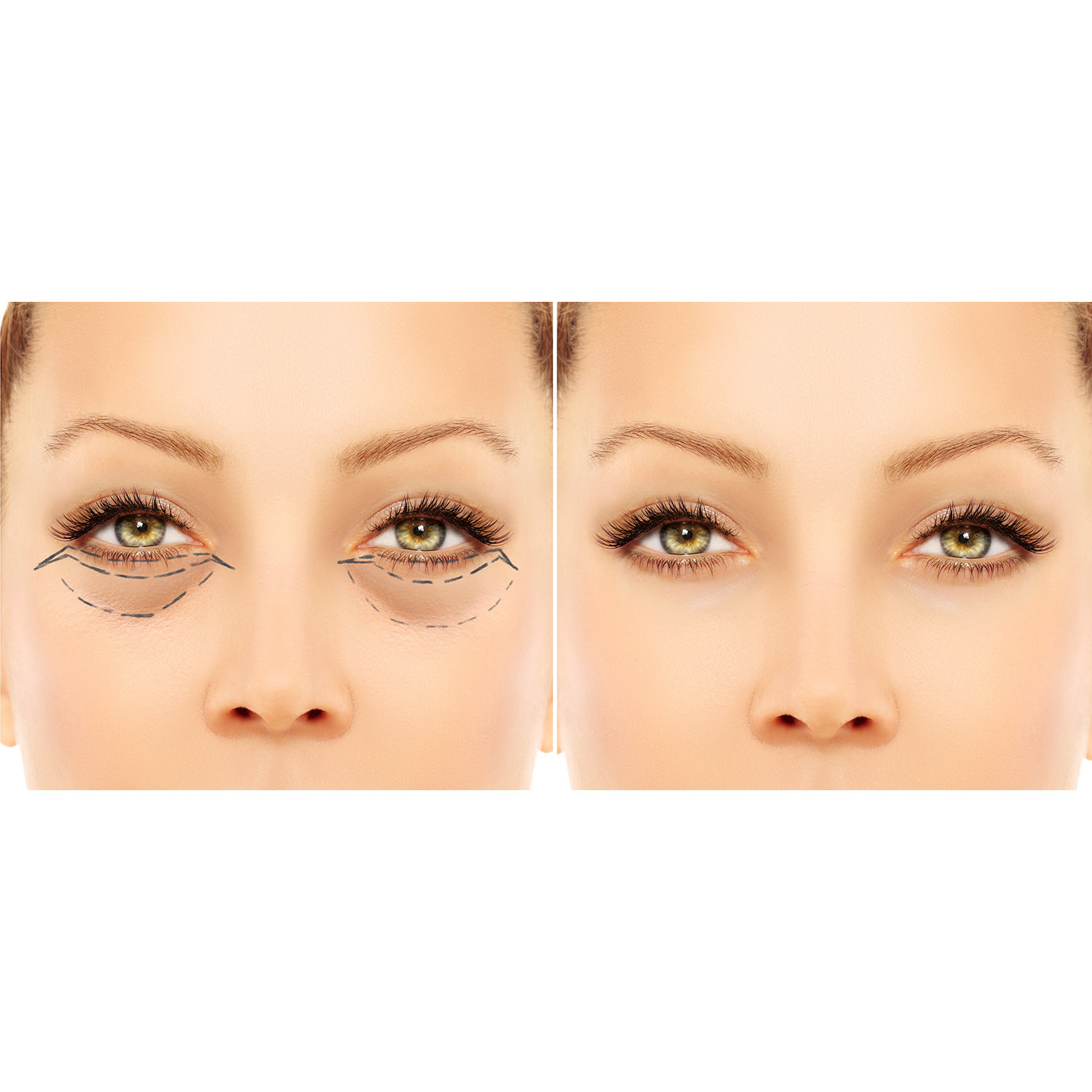 Estetska kirurgija – Korekcija očnih kapaka – Lege Artis 001